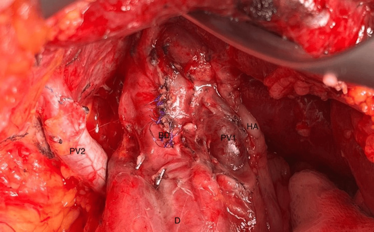 Intraoperative image showing the double portal anatomy; duodenum (D), hepatic artery (HA), common bile duct (BD), first portal vein going into the liver at its hilum (PV1), second portal vein going into the liver at segment VI (PV2).