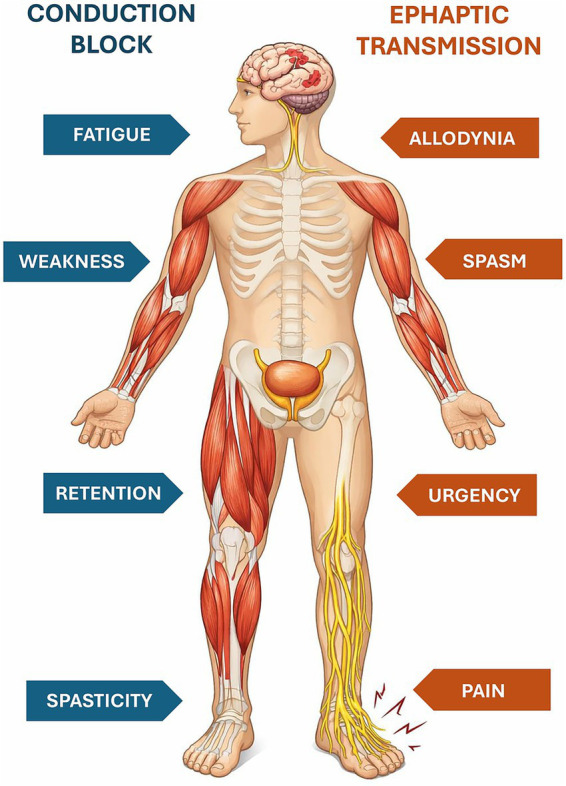 Medical illustration showing a human figure with nerves and muscles visible, listing symptoms associated with conduction block (fatigue, weakness, retention, spasticity) on the left and ephaptic transmission (allodynia, spasm, urgency, pain) on the right.