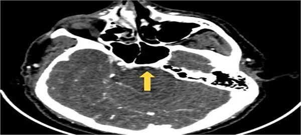 Axial CTA image of the brain demonstrating abrupt loss of contrast opacification at the proximal basilar artery (arrow), consistent with acute basilar artery occlusion.