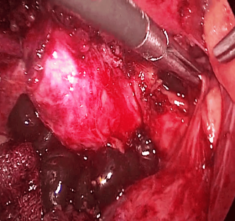 Multiple CBD calculiCBD: common bile duct