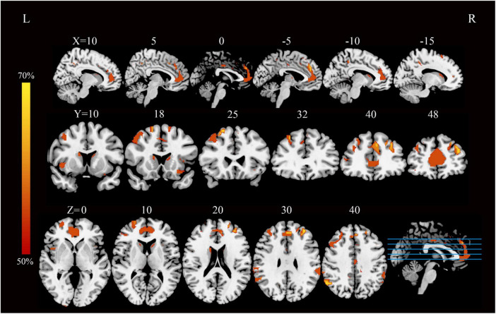 Brain imaging showing activation maps from functional MRI scans. Three rows display sagittal, coronal, and axial slices with overlays of brain activity in varying shades of orange. Color bar on the left indicates activity intensity from fifty to seventy percent. Coordinates X, Y, and Z are specified for each column.
