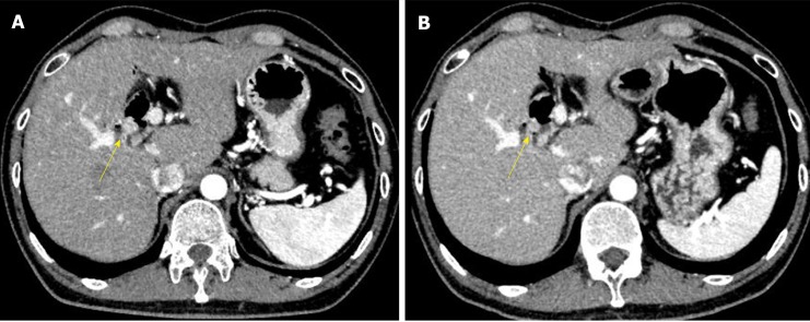 Abdominal CT images with contrast. A: Five and a half years after his first operation; B: Six years after his first operation. The images show a gradually growing nodule with contrast over a half a year (yellow arrow).