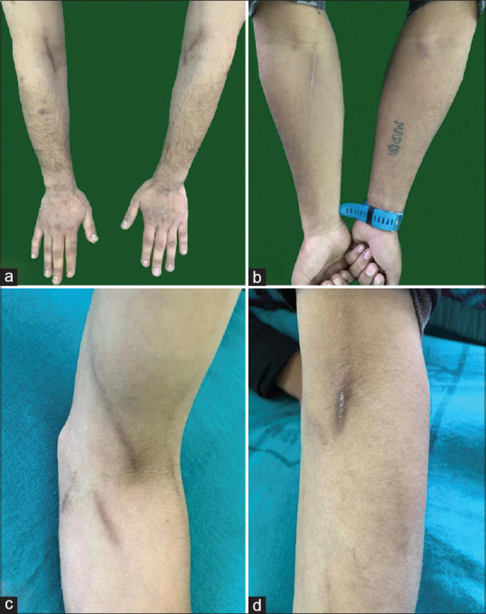 Track marks: Linear post-inflammatory hyperpigmentation at intravenous injection sites (a, b, c and d). Sooting tattoos formed due to injection of heroin with hot needles in cases of injectable heroin users (c and d)
