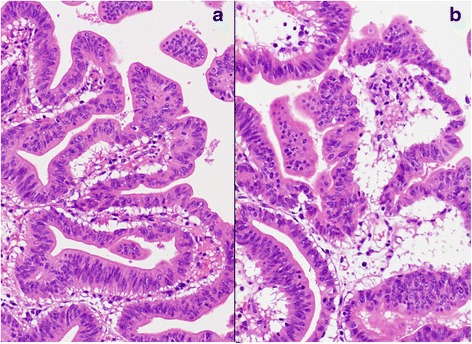 a, b Pathological examination revealed a well-differentiated tubular adenocarcinoma in the inferior bile duct (a) (hematoxylin and eosin (H.E., ×120) and middle bile duct (b) (H.E., ×120)