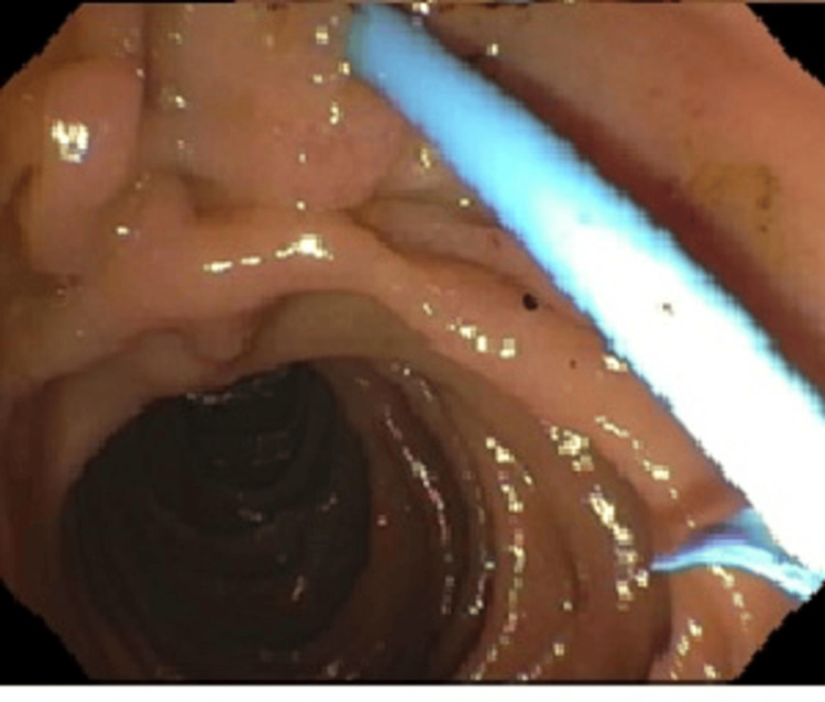External flap plastic stent in the common bile duct after dilation and removal of stones in the biliary duct