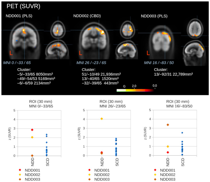Voxel-wise statistical comparisons in three patients with neurodegenerative diseases (NDDs; primary lateral sclerosis [PLS] for NDD001, corticobasal degeneration [CBD] for NDD002, and PLS for NDD003) regarding standardized uptake value ratio (SUVR) from positron emission tomography (PET) by whole brain-based spatial statistics (WBSS) against 19 individuals with subjective cognitive deficits (SCDs), considering false-discovery rate (FDR) adjustments. Maximum of cluster coordinates (in Montreal Neurological Institute [MNI] space) and sizes are provided. Hot color clusters indicate decreases, while cold color clusters (in NDD001 and NDD002) indicate increases in SUVR. Additionally, region of interest (ROI) analysis results for ROIs at locations of maximum alteration clusters are shown in comparison to subjects with SCDs, respectively. “L” indicates the left hemisphere.