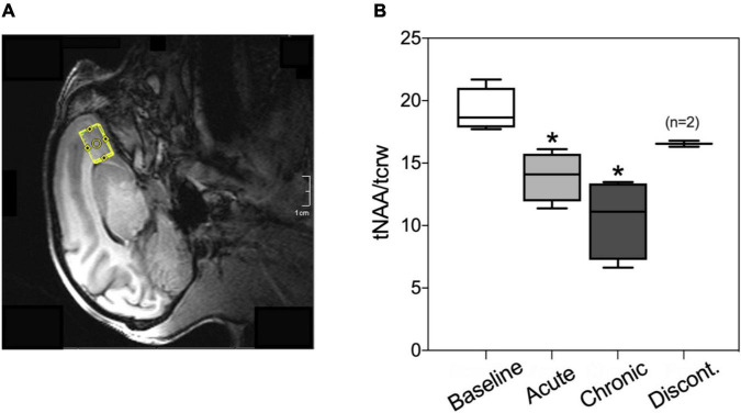 (A) Representative voxel placement for spectroscopy measurement at medial orbitofrontal cortex (mOFC) in rhesus macaques. (B) Boxplots of N-acetylaspartate/creatine ratio (tNAA/tCrw) during baseline, acute administration of AM2389 (10 μg/kg), during chronic AM2389 treatment (total dose 0.32 mg/kg), and 30 days after treatment discontinuation. *p < 0.05 vs. Baseline (N = 4).