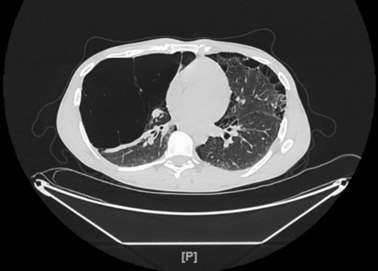 Chest CT scan transverse view showing severe bilateral apical bullous emphysema without pneumothorax.