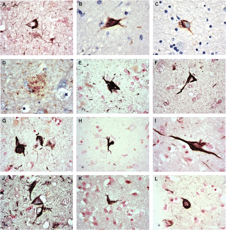 Representative pThr175 tau pathology in each neurodegenerative disease. a AD Frontal cortex, b ALS amygdala, c ALSci amygdala, d ALSci hippocampus neuritic plaque, e CBD entorhinal cortex, f DLBD amygdala, g mDLBD entorhinal cortex, h FTLD putamen, i MSA amygdala, j PD amygdala, k Pick’s entorhinal cortex, l VD anterior cingulate cortex. Nuclear fast red or hematoxylin counterstain used. Original images taken at 100×