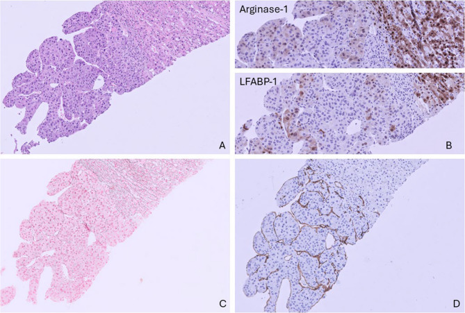Liver biopsy showing a moderately differentiated hepatocellular carcinoma in a noncirrhotic background. Standard HE staining, 20X magnification (a). Variable cytoplasmic and nuclear positivity of Arginase-1 and LFABP-1 in the tumor cells (b). Gomori’s silver stain showing fragmentation and loss of the reticuline network (c). Diffuse capillarization of sinusoids confirmed by CD34 stain (d)