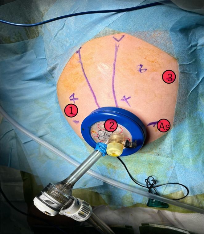 Port placement for robotic‐assisted surgery. Three robotic ports and one assistant port were strategically positioned as illustrated, following our standard protocol for robotic biliary surgery.