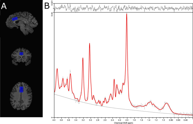 (A) Placement of the supragenual anterior cingulate cortex (ACC) voxel and, (B) ACC 1H-MRS spectra from a representative subject.