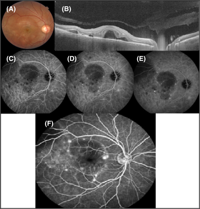 Multimodal imaging of the RE. Multiple foci of subretinal fluids (SRF) in macula with multiple areas of SRF and increased thickness of choroid are apparent in B‐scan OCT (A, B). Multiple hypocyanescence dark dots, a circular area of blocked fluorescence because of SRF, and enlarged and fuzzy choroidal blood vessels are visible in ICGA (C–E). Fluorescein angiography shows multiple pinpoint hyperfluorescence compatible with leakage (F).