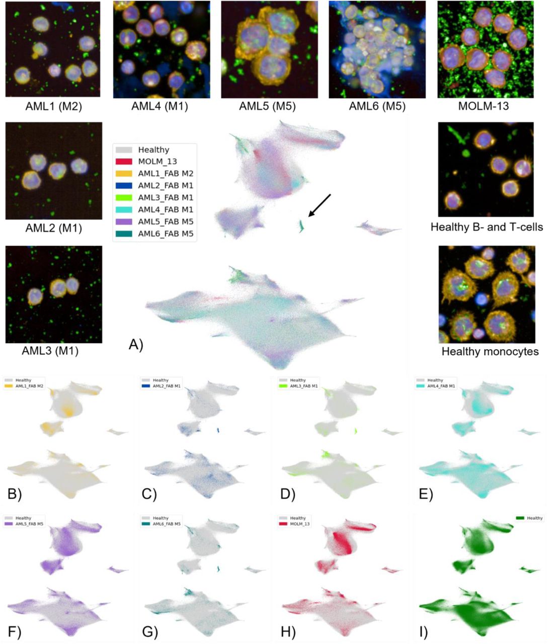 AML samples show a distinct distribution of BCP features compared to healthy donors.A) UMAP of BCP cellular features from AML patient and cell line samples with health PBMCs. Example images of each patient and cell line samples, as well as images of healthy B and T cells and monocytes. A cell cluster not found in healthy cells is indicated with an arrow. B-G) AML patient samples 1-6 and (H) the MOLM-13 sample compared to (I) healthy PBMCs.