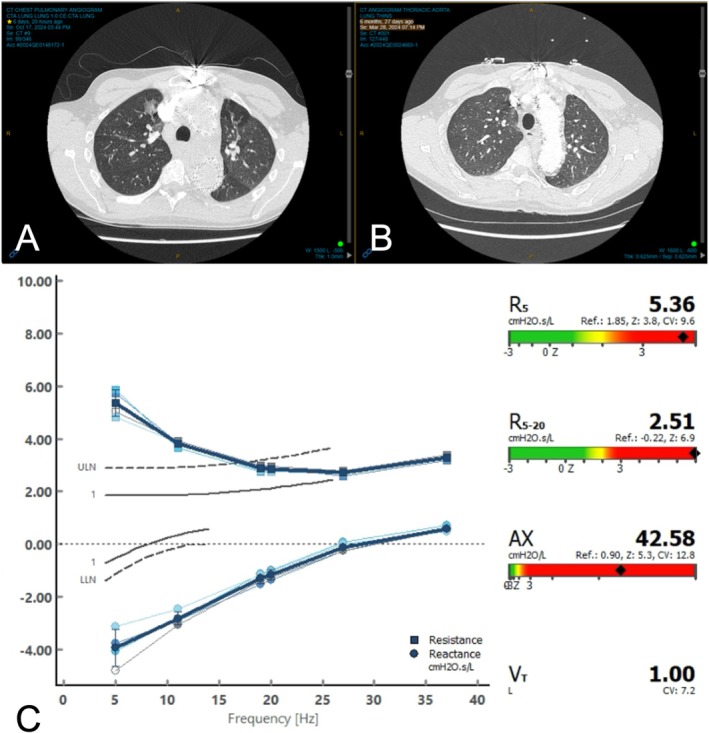 Diagnostic investigations at first presentation of adult‐onset asthma in a patient with Loeys‐dietz syndrome. (A) High‐resolution computed tomography (HRCT) of the chest during acute asthma exacerbation demonstrating bronchial wall thickening and mosaic attenuation consistent with small airway disease. (B) CT of the chest performed 6 months prior to presentation, in the absence of respiratory symptoms, showing persistent airway wall thickening. (C) Forced oscillation technique (FOT) measurements revealing elevated respiratory system resistance, supporting the diagnosis of small airway dysfunction.