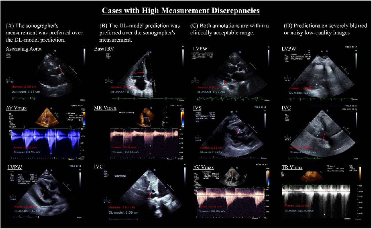 Representative Cases of High Measurement Discrepancies Analysis in Echocardiographic MeasurementsRepresentative echocardiography images of high measurement discrepancies analysis. Reviewed images were categorized into four categories; (A) cases where the reviewer considered that the sonographer’s measurement was preferred over the deep-learning (DL) model prediction, (B) cases where the DL model’s prediction was preferred over the sonographer’s measurement, (C) cases where both annotations (sonographer and DL model) were within a clinically acceptable range despite measurement variability, (D) cases where the echocardiographic images were severely noisy or blurred, considered inappropriate images for the DL-model input. Red texts and dots indicate sonographer measurements, and blue texts and dot show the DL model’s measurements. For a detailed explanation of echocardiography parameter abbreviations, refer to Supplemental Table 1.