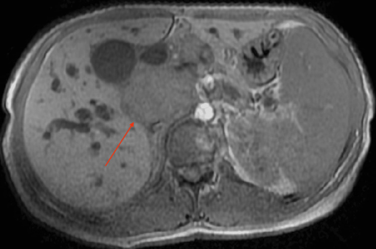 T1-weighted MRCP image showing a periportal lymph nodal massAxial T1-weighted MR image demonstrates a hypointense conglomerate lymph nodal mass in the periportal and peripancreatic region causing extrinsic compression of the common bile duct.
