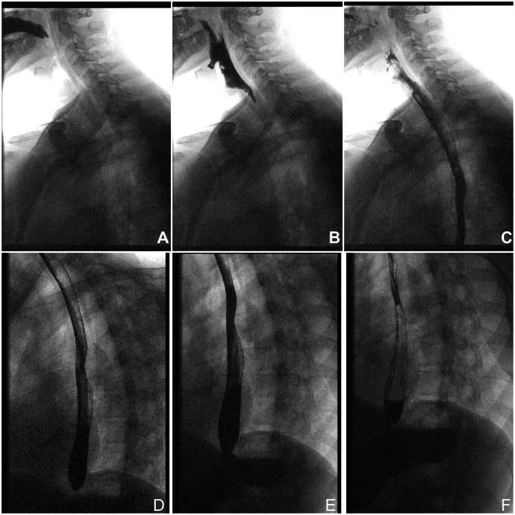 Contrast esophagogram demonstrating a normal esophagus, with no evidence of perforation or contrast extravasation.
