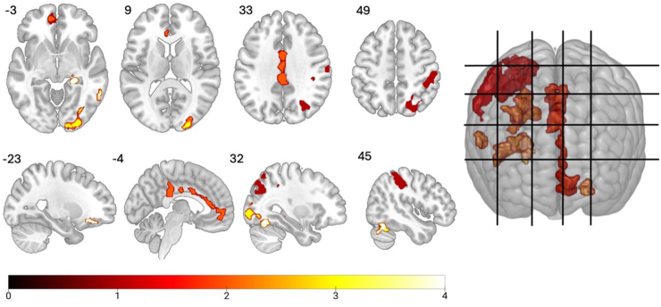 Overview of significantly greater brain activity (p < .05, familywise error corrected in axial, sagittal, and 3-dimensional views) in participants with a moderate-to-severe cannabis use disorder compared with control participants while viewing cannabis > neutral pictures. The color bar represents the t values for threshold-free cluster enhancement. These functional maps are overlaid on a Montreal Neurological Institute space template image. Gridlines represent the displayed slices.