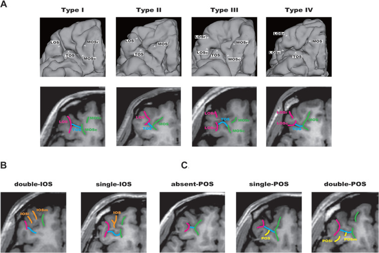Orbitofrontal cortex (OFC) sulcogyral pattern and its variation in human brain. (A) Patterns of the H-shaped sulcus are classified in 4 subtypes (type I, II, III, IV), according to the continuity of the lateral orbital sulcus (LOS) and medial orbital sulcus (MOS) (-r, rostral; -c, caudal). Type I: continuous LOS and discontinuous MOS. Type II: continuous LOS and MOS. Type III: discontinuous LOS and MOS. Type IV: discontinuous LOS and continuous MOS. (B) Variation of the intermediate orbital sulcus (IOS). The patterns are classified into 2 subtypes depending on the number of identified IOS (-m, medial; -l, lateral). (C) Variation of the posterior orbital sulcus (POS). The patterns are classified into 3 subtypes depending on the number of identified POS (-m, medial; -l, lateral). Panels A, B, and C were adapted and modified from a previous article by Watanabe et al. 19 Reprinted with permission of Oxford University Press.
