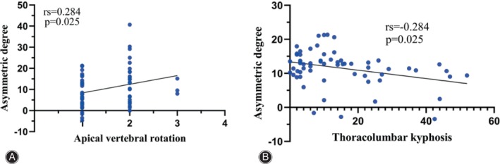 Graph showing the correlation between asymmetric degree in ES and AVR at the apex of the fractional curve (A), and that in MS and TLK at the apex of the main curve in Type A (B). ES, erector spinae; AVR, apical vertebral rotation; MS, multifidus; TLK, thoracolumbar kyphosis.