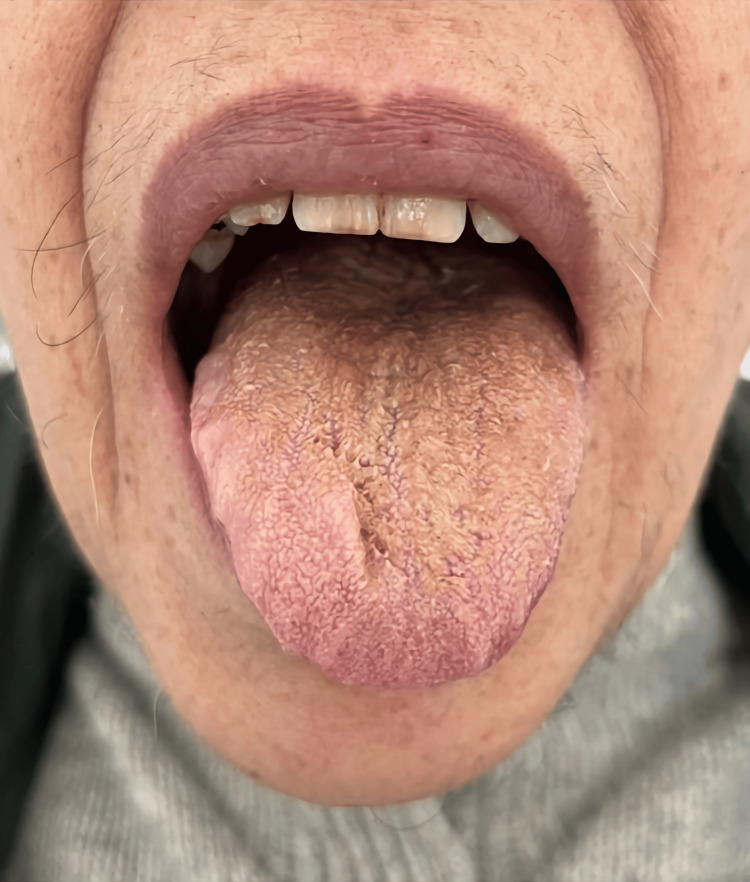 Black hairy tongue 10 days after discontinuation of olanzapine.Consent to publish the image was obtained from the patient.