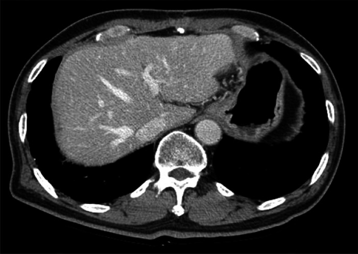 Three-month postoperative computed tomography scan shows no evidence of tumor recurrence.