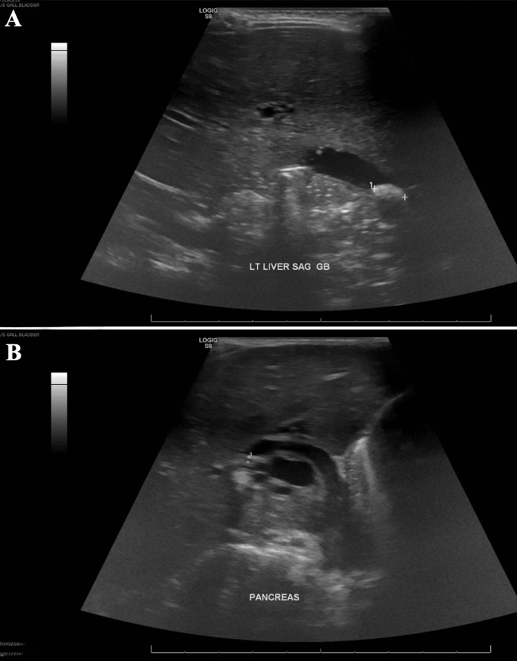 Repeat abdominal ultrasoundRepeat abdominal ultrasound (A: liver sagittal view, B: pancreas view) showing the intrahepatic ducts and CBD remaining dilated with multiple gallstones, the largest of which measuring 9 mm. No gallbladder wall thickening.CBD: common bile duct