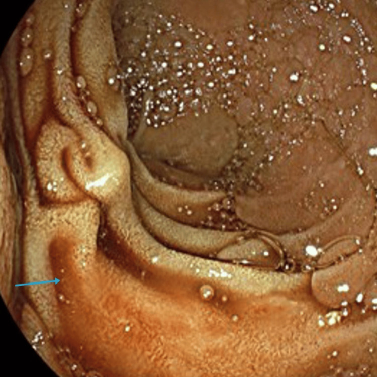 Duodenoscope along the ampulla post-suction of blood clots with a trace of remnant blood products in the duodenum (blue arrow).