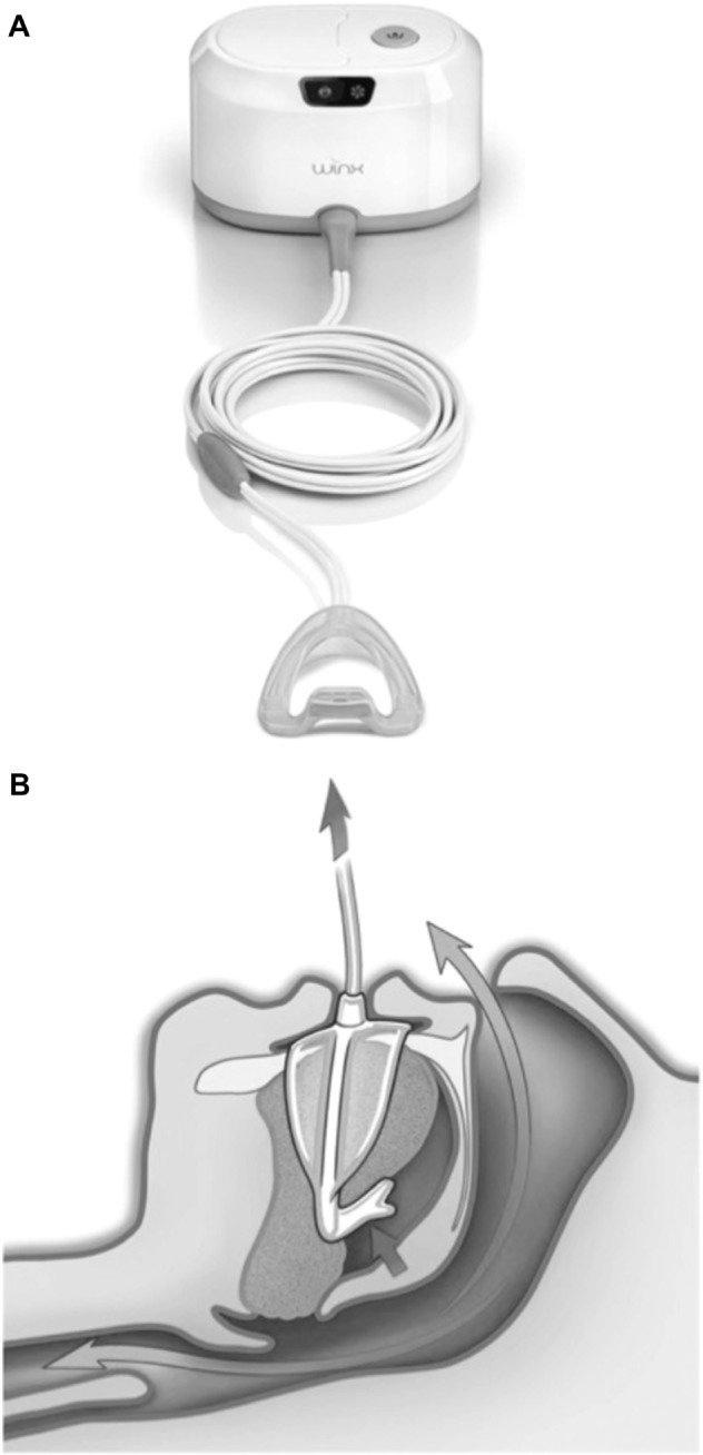 (A) Winx device, an oral pressure device that uses gentle suction to anteriorly and superiorly displace the tongue and the soft palate. (B) Effect of oral pressure device on the tongue and soft palate displacement.Notes: Copyright © 2013. Reproduced with permission from the American College of Chest Physicians. Park JG, Morgenthaler TM, Gay PC. Novel and emerging nonpositive airway pressure therapies for sleep apnea. Chest. 2013;144(6): 1946–1952.19