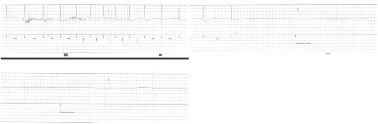 16 seconds asystole recorded by the ILR occurred around 1:00 a.m. while the patient was sitting, watching television
