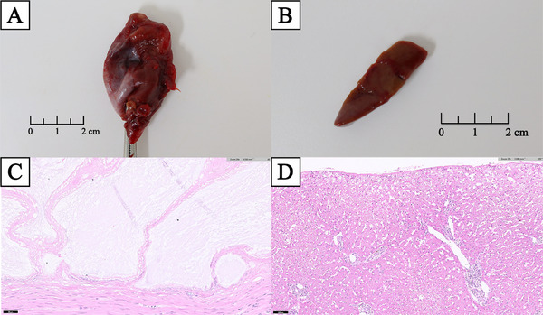 Resected tissue and histopathology of GB and liver biopsy. (A) Ruptured GB. (B) Liver biopsy of the left lateral liver lobe. (C) In the GB tissue slide, mucosal proliferation, multifocal mucosal ulceration, granulation tissue, accumulated luminal mucins, proteinaceous fluid, haemorrhage, and inflammation were observed. (D) In the liver tissue slide, lymphoplasmacytic and neutrophilic hepatitis, multifocal bile plug formation, bile stasis, biliary proliferation, and intrahepatocytic pigmentation, with extensive neutrophilic and fibrinous peritonitis, were observed.