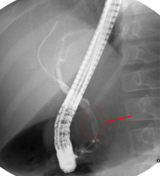 Cholangiogram at follow‐up ERCP performed 2 months after initial ERCP. Cholangiogram demonstrating resolution of previously seen CBD stenosis. Arrow demonstrating normalization of previously narrowed segment. CBD, common bile duct; ERCP, endoscopic retrograde cholangiopancreatography.