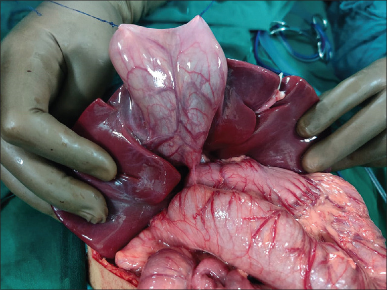 Exploration - double gallbladder