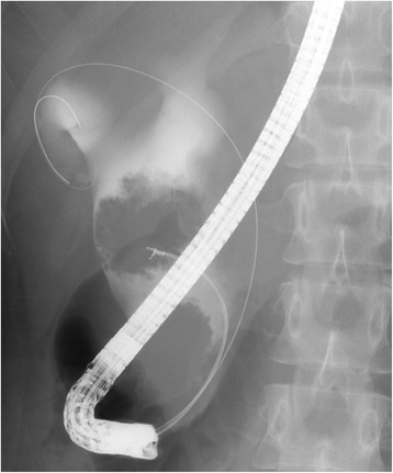 Endoscopic retrograde cholangiopancreatography showed two tumors, and biopsy of one of the tumors confirmed adenocarcinoma
