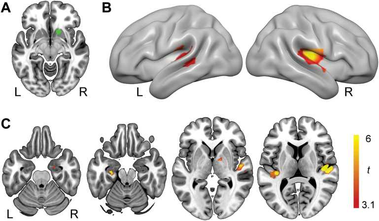 Functional connectivity analysis. (A) Seed region in right ventral striatum. (B) This seed region showed increased task-related functional connectivity with bilateral auditory cortex following cannabis with cannabidiol (CBD) compared with cannabis without CBD (C). Axial slices depicting the same data in bilateral auditory cortex and additional left hippocampal cluster. All activation maps visualized on MNI152 and thresholded at P<.05 (FDR corrected for multiple comparisons). L, left hemisphere; R,right hemisphere.