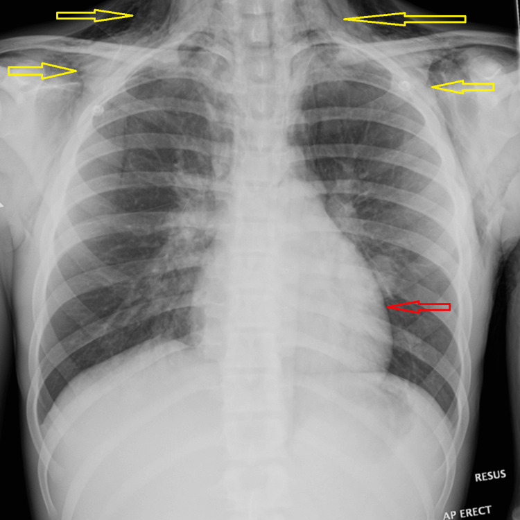 Chest X-rayAP erect chest radiograph showing diffuse subcutaneous emphysema (yellow arrows) tracking along the soft tissues of the neck and upper chest wall, with associated pneumomediastinum (red arrow).