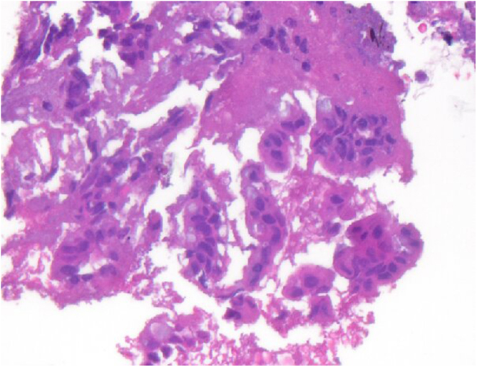 Pathology of CBD mucosa during the repeat ERCP showing the evidence of inflammation but no malignancy.