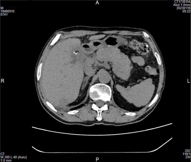 A high-density strip shadow can be seen near the T-tube sinus.
