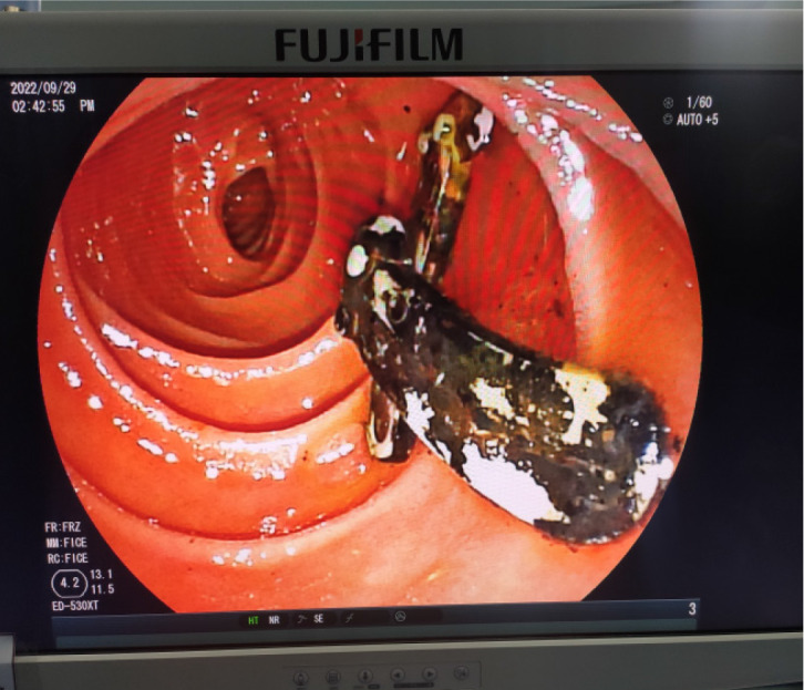 Endoscopic retrograde cholangiopancreatography shows a stone in the common bile duct centered on the Hem-o-lok clip.