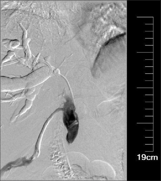The clip in common bile duct and it has not yet formed a stone