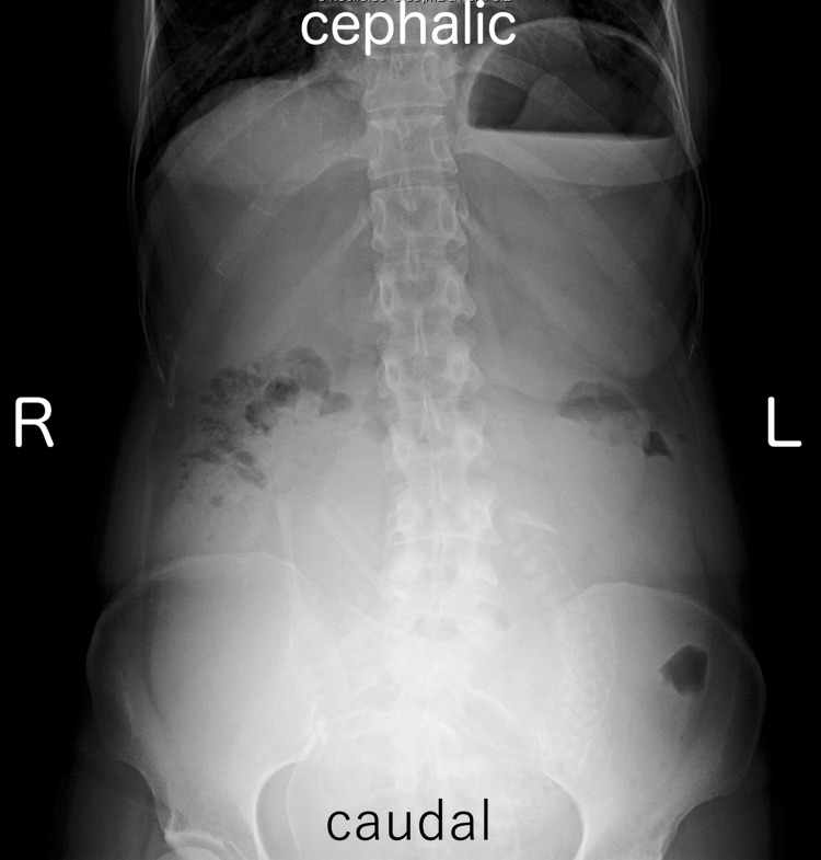 Abdominal X-ray in the upright position.There is no sign of niveau formation and distal small bowel gas.