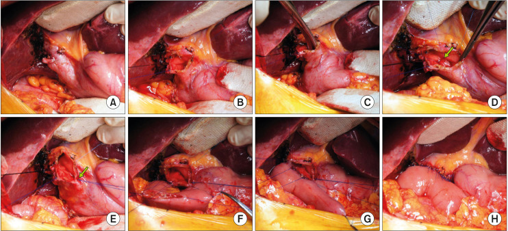 Intraoperative photograph showing the procedure of side-to-end choledochojejunostomy with intraluminal closure of the distal common bile duct (CBD) in Case No. 1. (A) The dilated CBD is visible after cholecystectomy. (B) The mid-portion of the CBD is incised longitudinally, showing markedly thickened CBD wall indicating repeated episodes of cholangitis. (C) The distal CBD is explored with curved stone forceps to examine the opening status of the sphincter. (D, E) The lumen of the distal CBD at the upper board of the pancreas is securely closed with 5-0 Prolene running sutures twice. The suture knots are made at the outer surface of the CBD (arrow). A part of the anterior wall of the CBD is excised to widen the opening. (F-H) A Roux-en-Y jejunal limb is anastomosed to the CBD opening in a side-to-side fashion.