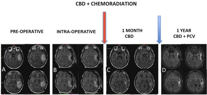 (A) MRI showed expansive infiltrative lesion predominantly subcortical of poorly defined contours, located in the left temporal lobe, involving the upper, middle and lower temporal gyrus, with increase of the left temporal gyrus cortex. The lesion compromises a large part of the temporal lobe and extends to the temporal isthmus, posterior aspect of the insula, and deeply to the trigeminal effigy of the left lateral ventricle. There is diffuse erasure of the regional cortical sulci and the Sylvian fissure, as well as slight compression over the atrium of the left lateral ventricle. (B) Intraoperative MRI. Red arrow: chemoradiation associated with cannabidiol in a dosage ranging from 100 to 200 mg/day. (C) MRI control right after chemoradiation was characterized post-operative changes associated with a significant reduction of the infiltrative components of the tumor. (D) Magnetic resonance control after 1 year characterized no evidence of disease progression.
