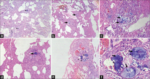 (a) Microscopic view shows lung parenchyma with foreign material (arrow) and congested blood vessels, H and E stain, ×100 in Case no. 1, (b) The microscopic view shows lung parenchyma with foreign material (arrow) and congested blood vessels, with an H and E stain of × 100 in Case no. 3, (c) Numerous pale gray-blue to basophilic excipients (arrow) are seen mainly in the alveolar septa H and E stain, ×200 in Case 5, (d) Pale gray-blue to basophilic excipient (arrow) in the interalveolar region, H and E stain, ×200 in Case no. 7, (e and f) Pale gray-blue to basophilic excipient (arrow) inside a blood vessel (arrowhead), H and E stain, ×200 and × 400 in Case no. 8