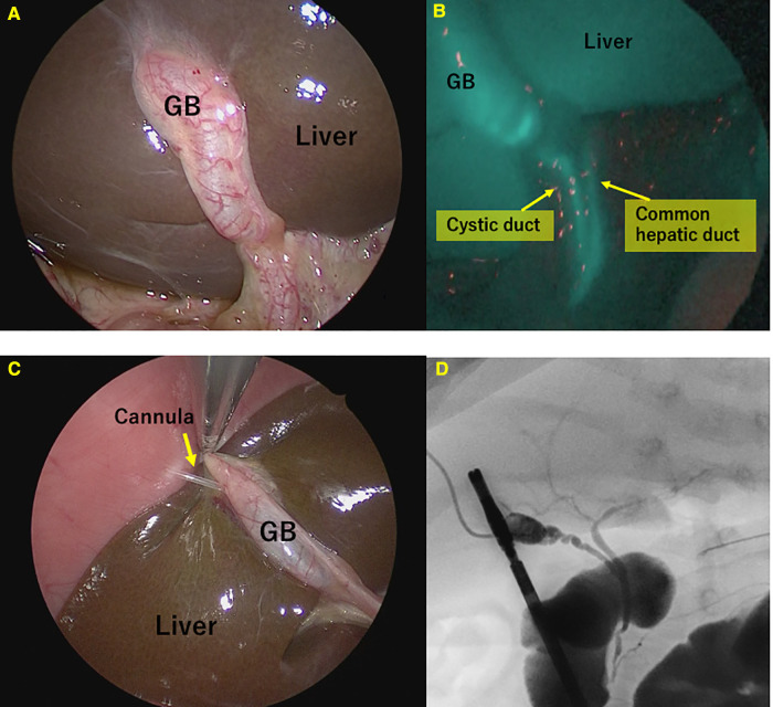Fluorescence and conventional cholangiography for non-biliary atresia (BA) patients. (A) Normal view. (B) Fluorescence cholangiography. (C) Cannulation of the gallbladder. (D) Conventional cholangiography.