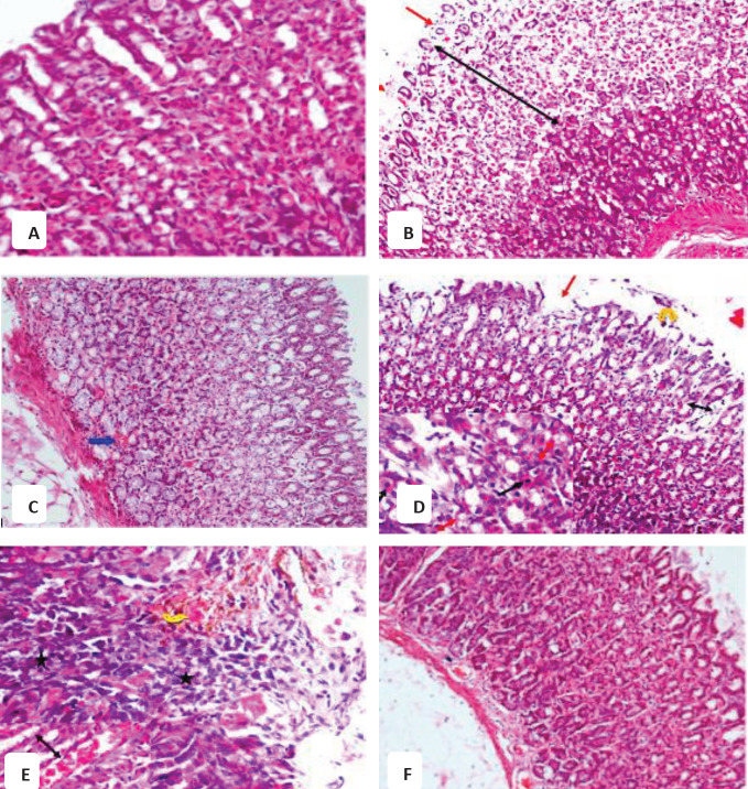 Representative photomicrographs of rat gastric mucosa sections after treatment with (A) vehicle showing normal structure; (B) WIR-stress plus vehicle showing a highly extensive gastric lesion in the form of gastric damage in the gastric mucosa, destruction, and shedding of the upper 2/3 of the gastric gland at this area; (C) WIR-stress plus NADA showing the normal architecture of the gastric gland, but the congestion of blood vessels could be observed; (D) WIR-stress plus rimonabant showing focal erosive ulcer (red arrow) and exfoliation of the focal area of superficial epithelium cells (yellow arrow) vacuolar degeneration in the epithelium lining of the gland (double red arrow). Some cells of the gastric gland appear with pyknotic nuclei while others appear with fading nuclei at the left of the figure; (E) WIR-stress plus GW 405833 showing inflammatory infiltrates (star) and hemorrhage (yellow arrow) and congested blood vessels in lamina propria (black arrow); (F) WIR-stress plus AM630 showing some improvement in histological changes in the form of no ulcer observed (H&E x200)