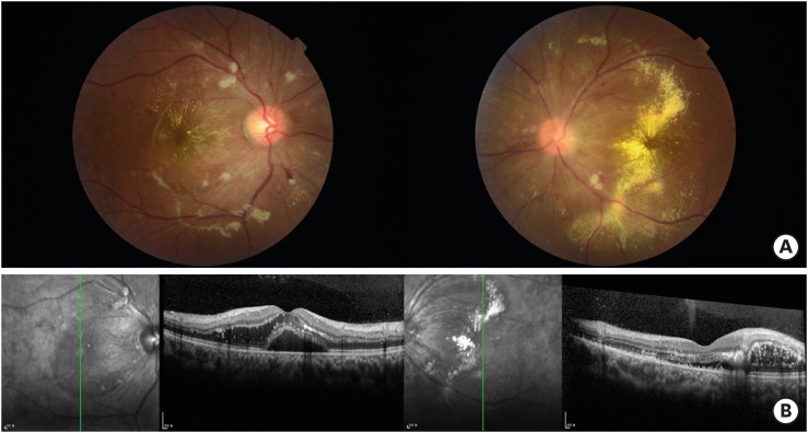 Ophthalmologic examination. (A) Retinal hemorrhage, cotton wool spot and severe exudate on fundus examination and (B) serous retinal detachment and intraretinal fluid on both eyes on optical coherence tomography.