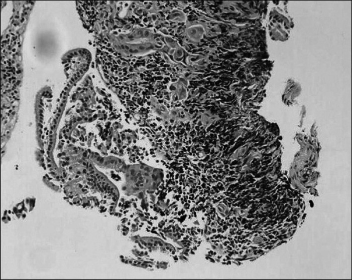 Hematoxyline-eosin staining of CBD biopsy slide shows a few atypical cells in lymphocytic background, suspicious for adenocarcinoma (×200).