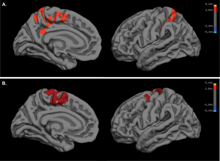 Brain maps for vertex-wise analyses. (A) Brain map of the left hemisphere of a cluster with the peak vertex located in the left precuneus (P < .001). (B) Brain map of the left hemisphere of a cluster with the peak vertex located in the left superior frontal gyrus (P = .001).